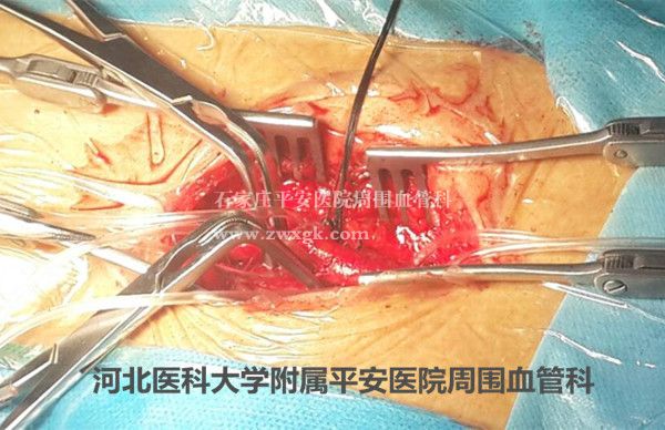 术野暴露,解剖出来的股动脉及股深、股浅动脉的控制